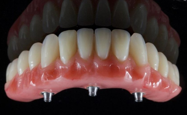 Bedančio žandikaulio dantų implantavimas