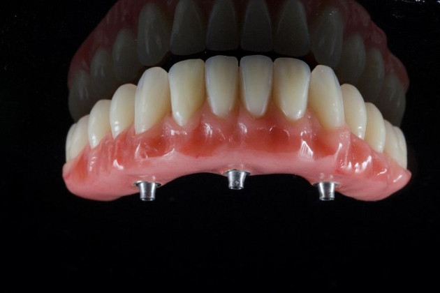 Dantų implantavimo sistema TREFOIL – viso žandikaulio dantys per vieną dieną