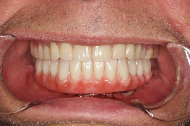 Dantų implantavimo sistema TREFOIL – viso žandikaulio dantys per vieną dieną