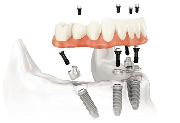 Dantų implantai VISI ANT 4