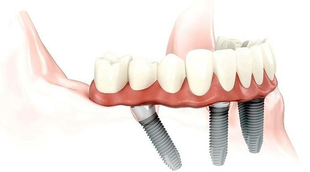 Dantų implantai VISI ANT 4
