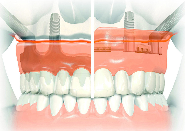 Greitas ir efektyvus dantų implantavimas