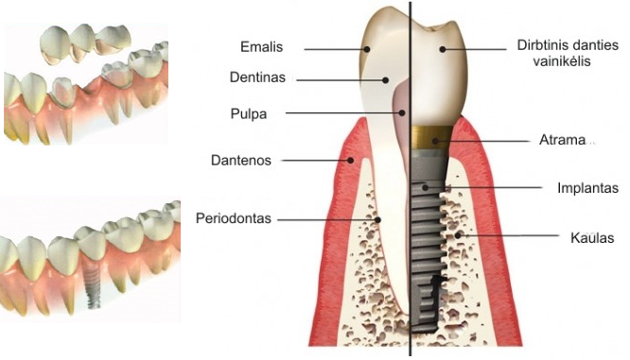 Dantų implantavimas: Kuo dantų implantacija pranašesnė už kitus dantų atstatymo būdus?