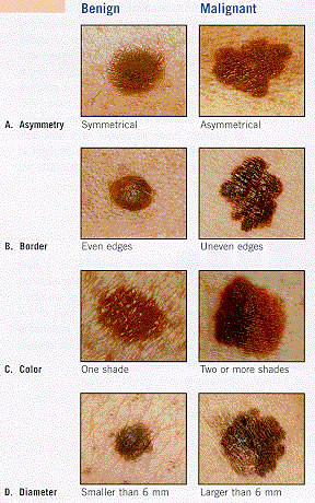 Melanoma  -  tyli, bet grėsminga odos liga