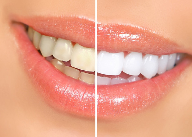 Dantų balinimas – gražios šypsenos garantija
