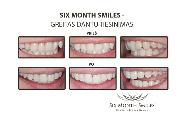 Dantų tiesinimas SIX MONTH SMILES programa