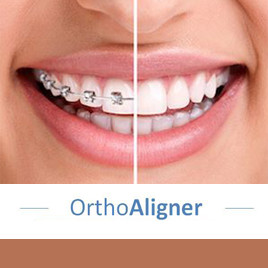 Dantų tiesinimui – skaidrios kapos OrthoAligner