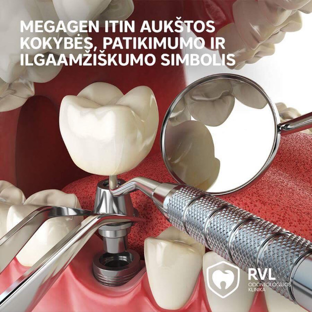 Kokybiški ir patikimi dantų implantai – kaip neapsirikti?
