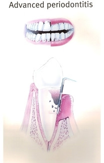 Paradontozės simptomai ir gydymas: Kaip laiku užkirsti kelią periodonto ligoms