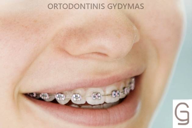 Ortodontinis gydymas - kreivai išdygusiems dantims ištiesinti, netaisyklingo sukandimo gydymui, bei veido-žandikaulių sistemos vystymosi sutrikimų korekcijai