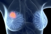 Krūties vėžys ir medicinos mitai: 15 klaidingų nuomonių apie krūties vėžį