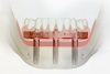 Bedančio žandikaulio dantų implantavimas per 1-ną dieną – unikali TREFOIL sistema