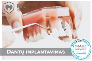 Dantų implantai puikus, greitas ir neskausmingas sprendimas