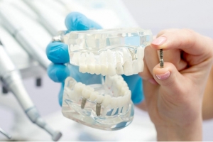 Dantų implantai – optimalus sprendimas, grąžinantis žmonėms prarastus dantis